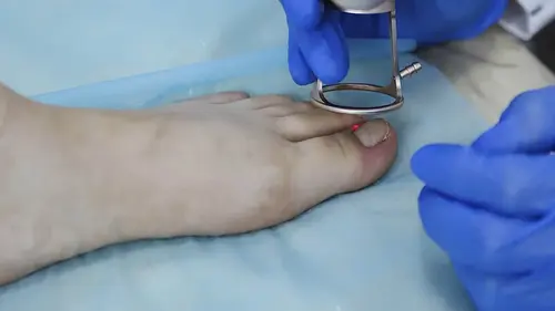 Odstránenie zarastajúceho nechtu na nohe